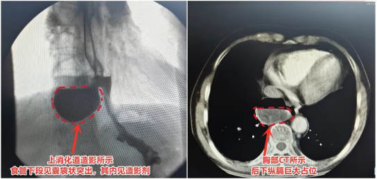 食管竟“塌陷”出6cm×5cm深坑！市二院胸心外科完成一例胸腔镜下巨大食管憩室切除术2589.png